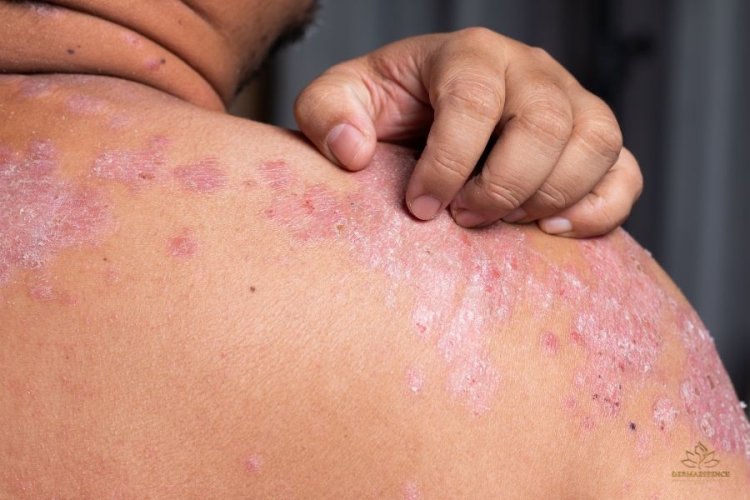 Psoriasis