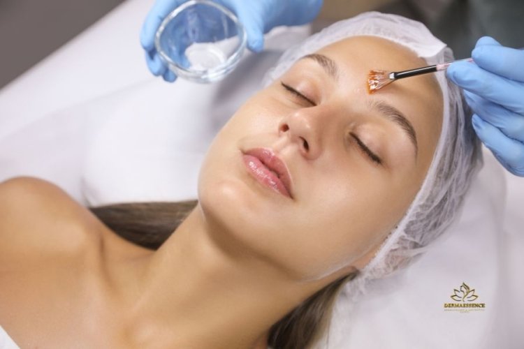 Peeling químico