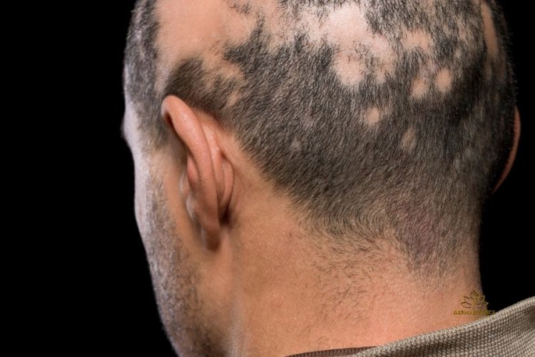 Alopecia Androgénica