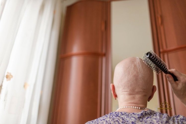 Alopecia Areata