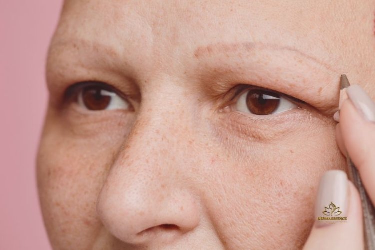 Alopecia de Cejas y Pestañas