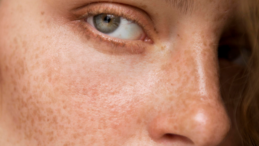 Melasma
