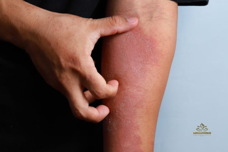 Dermatitis Atópica