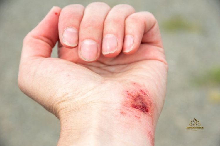 Cauterización de Lesiones