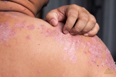 Psoriasis