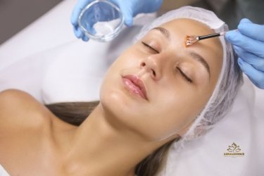 Peeling químico
