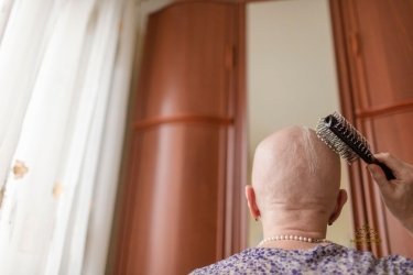 Alopecia Areata