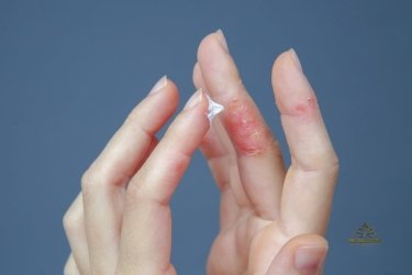 Dermatitis de Contacto