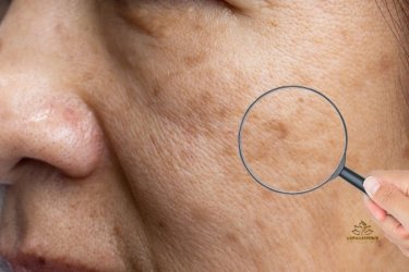 Melasma